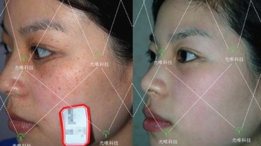 美白未來，科美顏SMB色素管理中心助你換新容顏。
