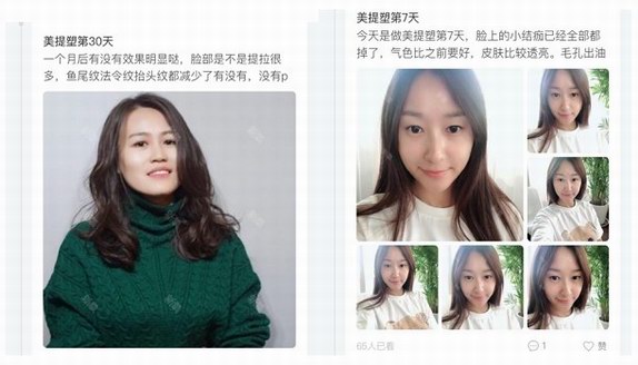美提塑熱水光一夜興起，成為愛美人士的逆齡新寵